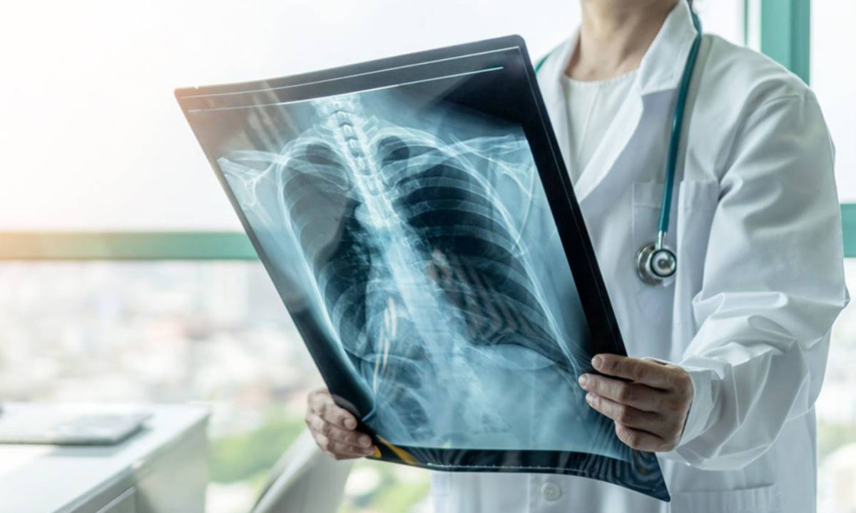 Aumentan los casos de tuberculosis en Chile: Autoridades sanitarias en alerta